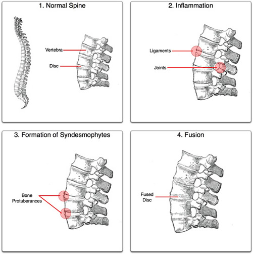 Ankylosing Spondylitis - A Common Cause Of Back Pain 